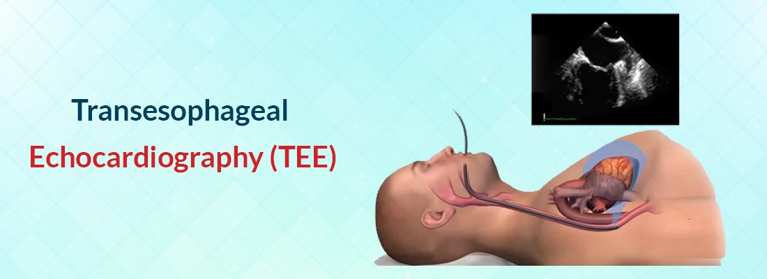 Transesophageal Echocardiography